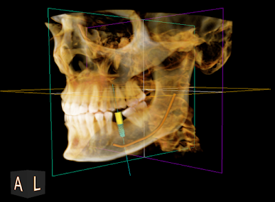 Dental implant placement using advanced robot-guided technology